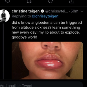 Chrissy Teigen : Victime d'un angio-oedème à la bouche le 16 août 2019.