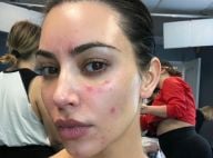 Kim Kardashian, malade : elle dévoile les ravages du psoriasis