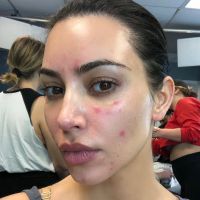 Kim Kardashian, malade : elle dévoile les ravages du psoriasis