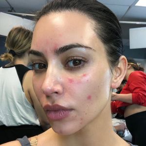 Kim Kardashian dévoile les ravages du psoriasis. Septembre 2019.