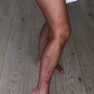 Kim Kardashian dévoile les ravages du psoriasis. Septembre 2019.