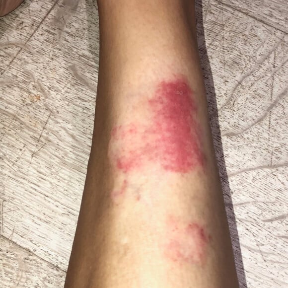 Kim Kardashian dévoile les ravages du psoriasis. Septembre 2019.