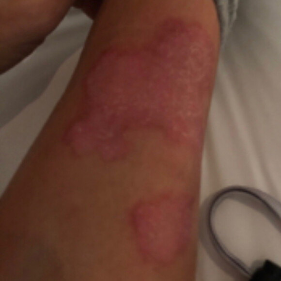 Kim Kardashian dévoile les ravages du psoriasis. Septembre 2019.