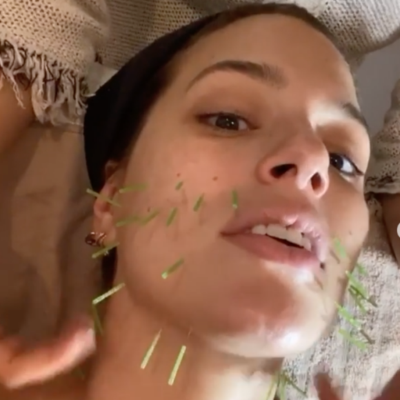 Ashley Graham, enceinte, en pleine séance d'acuponcture. Le 5 décembre 2019 sur Instagram.