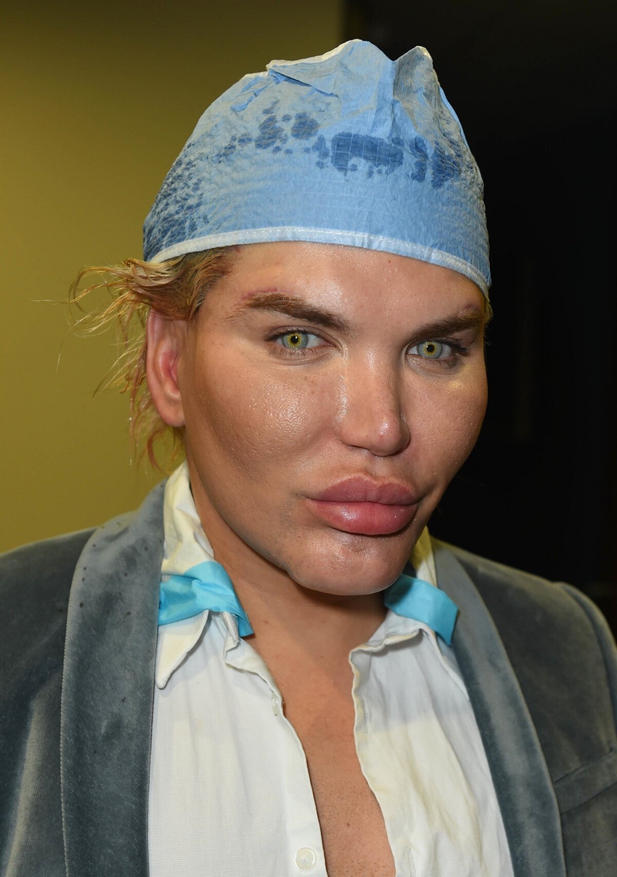 Vidéo Exclusif Rodrigo Alves Se Promène Avec Un Chapeau Sur La Tête Suite à Des Implants