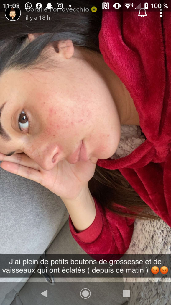 Coralie Porrovecchio enceinte et pleine de boutons, le 3 avril 2020, sur Snapchat