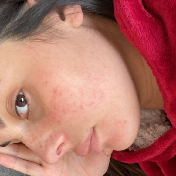 Coralie Porrovecchio enceinte et pleine de boutons, le 3 avril 2020, sur Snapchat