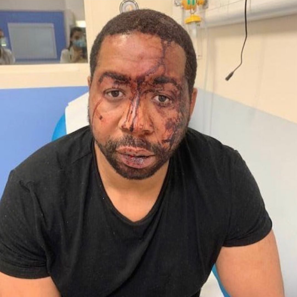 Michel Zecler, le visage en sang après son agression policière filmée. Novembre 2020.