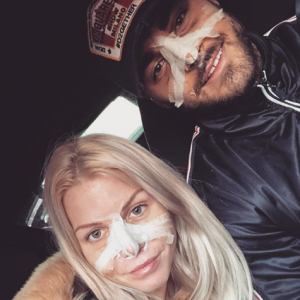 Jessica Thivenin et Thibault Kuro se sont fait refaire le nez, le 19 janvier 2018.