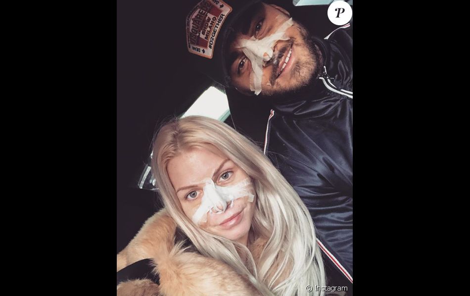 Jessica Thivenin et Thibault Kuro se sont fait refaire le nez, le 19 janvier 2018.