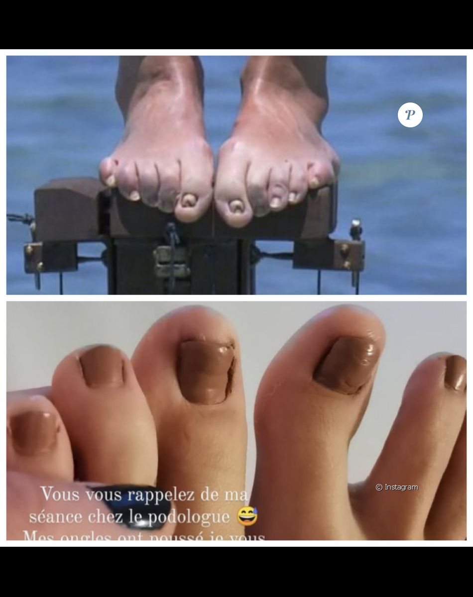 L'avant/après impressionnant des pieds d'Alexandra, gagnante de "Koh-Lanta, Les 4 Terres".
