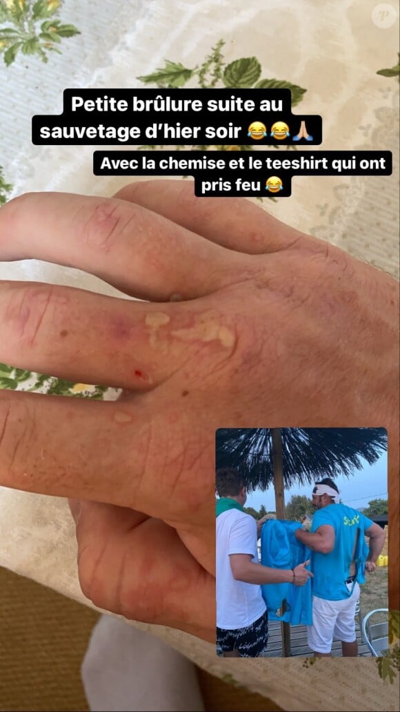 Loïc (Koh-Lanta) dévoile sa main brûlée suite à un "sauvetage" dans un camping - Instagram