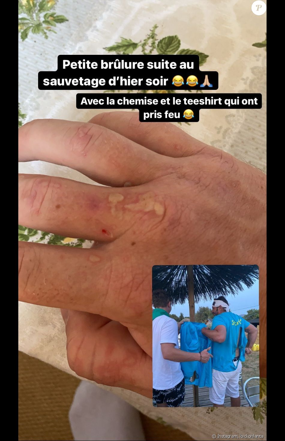 Loïc (Koh-Lanta) dévoile sa main brûlée suite à un "sauvetage" dans un camping - Instagram