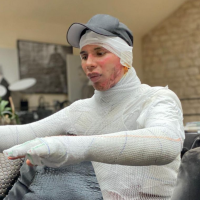 Olivier Rousteing, défiguré dans une explosion : il revient sur le drame