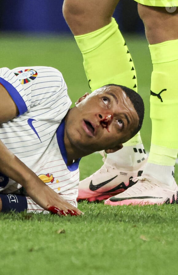 
Kylian Mbappé a été victime d'une fracture du nez lors du du match du groupe D de l'Euro 2024 entre l'équipe de France face à l'Autriche (1-0) à Dusseldorf en Allemagne le 17 jun 2024. Sorti avec le nez cassé après un choc avec Kevin Danso, Kylian Mbappé a passé des premiers examens qui laissent place à l'optimisme. L'intervention chirurgicale est écartée " dans l'immédiat ", selon la FFF.