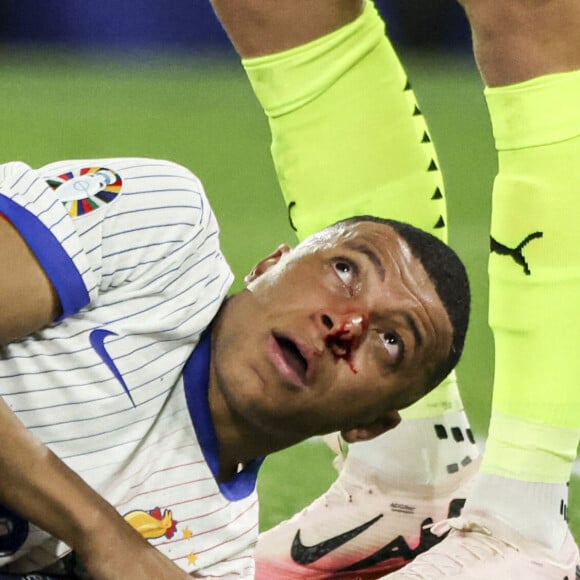 
Kylian Mbappé a été victime d'une fracture du nez lors du du match du groupe D de l'Euro 2024 entre l'équipe de France face à l'Autriche (1-0) à Dusseldorf en Allemagne le 17 jun 2024. Sorti avec le nez cassé après un choc avec Kevin Danso, Kylian Mbappé a passé des premiers examens qui laissent place à l'optimisme. L'intervention chirurgicale est écartée " dans l'immédiat ", selon la FFF.