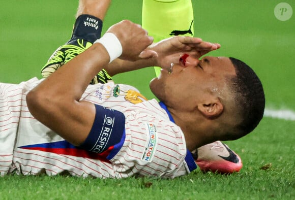 
Kylian Mbappé a été victime d'une fracture du nez lors du du match du groupe D de l'Euro 2024 entre l'équipe de France face à l'Autriche (1-0) à Dusseldorf en Allemagne le 17 jun 2024. Sorti avec le nez cassé après un choc avec Kevin Danso, Kylian Mbappé a passé des premiers examens qui laissent place à l'optimisme. L'intervention chirurgicale est écartée " dans l'immédiat ", selon la FFF.