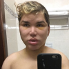 Rodrigo Alves est mal en point après sa 50e opération de chirurgie esthétique. Photo publiée sur Instagram à la fin du mois de janvier 2017