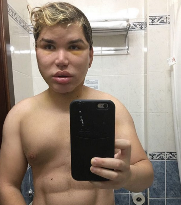 Rodrigo Alves est mal en point après sa 50e opération de chirurgie esthétique. Photo publiée sur Instagram à la fin du mois de janvier 2017