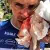 Yoann Offredo en sang après une violente agression.