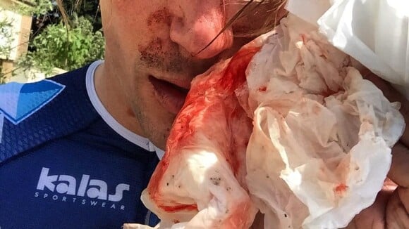 Yoann Offredo : Le cycliste agressé au cutter et à la batte de base-ball