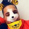 Eddy les yeux gonflés après son opération de chirurgie, Snapchat, mars 2017