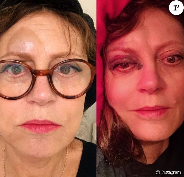 Susan Sarandon Tres Amochee Le Nez Casse Elle Lance Un Appel D Urgence Purepeople