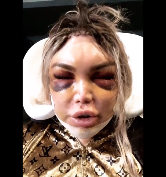 Roddy Alves après une opération pour féminiser les traits de son visage. Instagram. Le 17 février 2020.