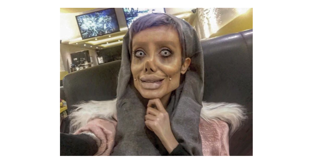 Chirurgie Pour Ressembler A Angelina Jolie