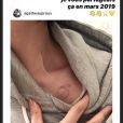 Agathe Auproux célèbre son premier anniversaire de "santé retrouvée". Le 24 juin 2019, la jeune femme annonçait être guérie de son cancer.