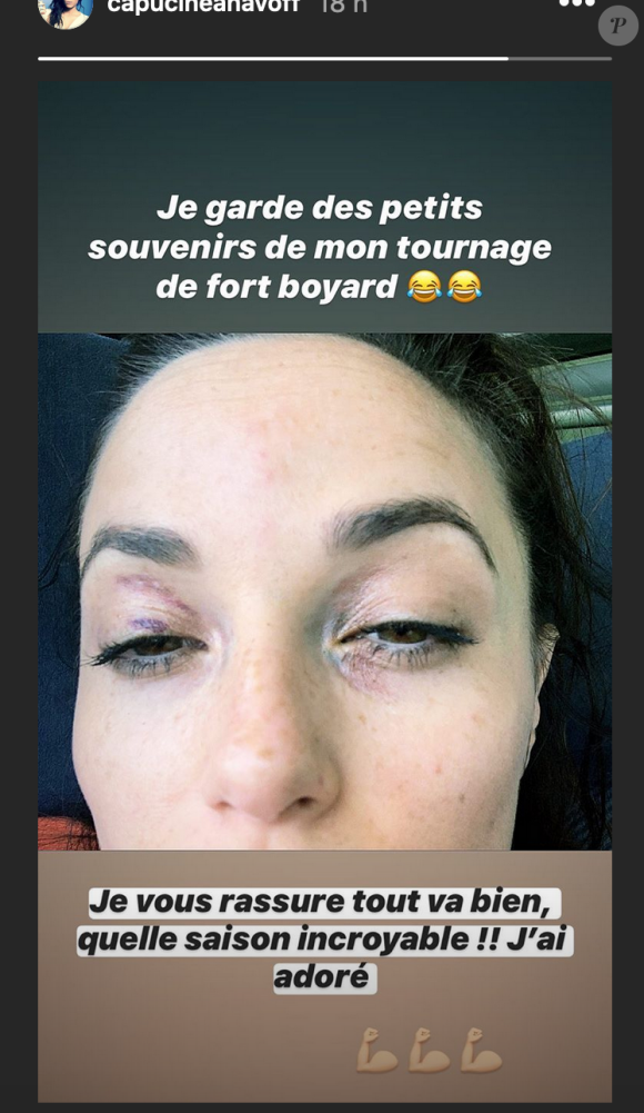 Capucine Anav dévoile son visage blessé après le tournage de Fort Boyard - Instagram, 24 juin 2020