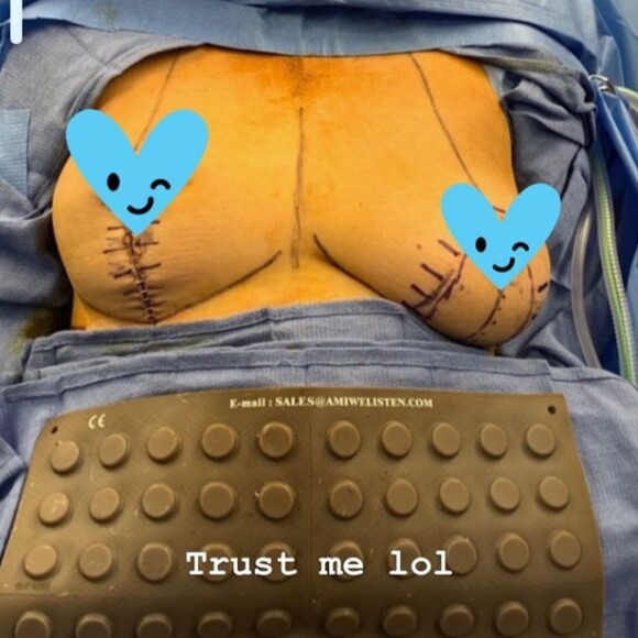 Chrissy Teigen dévoile la répugnante photo de son opération des seins. juillet 2020.