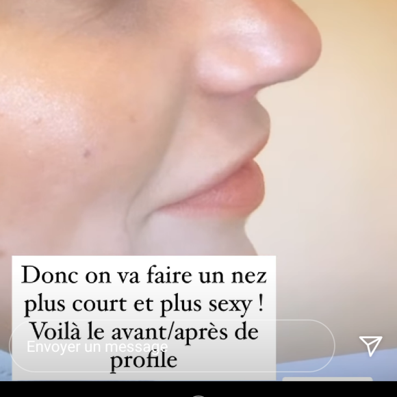 Nadège Lacroix fait une nouvelle rhinoplastie, le 8 décembre 2020