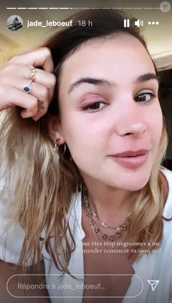 Jade Leboeuf en vacances à Saint-Barthélémy souffre d'une infection à l'oeil - Instagram