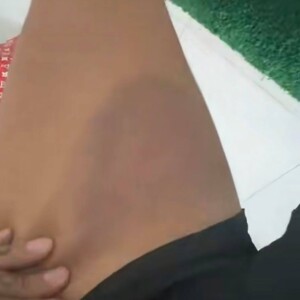 Thibault Garcia montre sa nouvelle blessure à la jambe sur Snapchat.