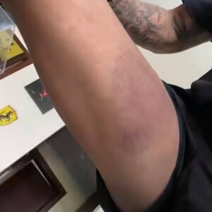 Thibault Garcia montre sa nouvelle blessure à la jambe sur Snapchat.