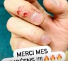 Vianney montre ses doigts englansantés après un concert. @ Instagram / Vianney