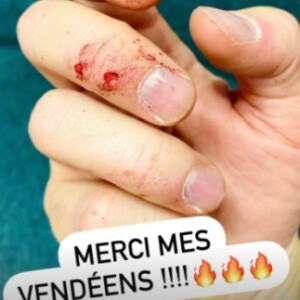 Vianney montre ses doigts englansantés après un concert. @ Instagram / Vianney