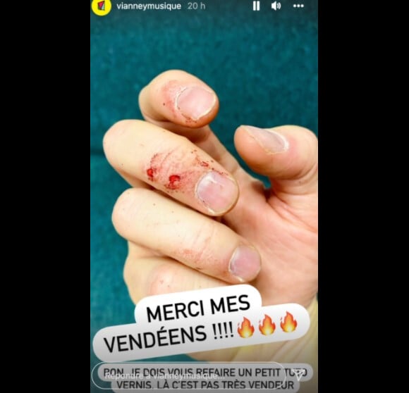 Vianney montre ses doigts englansantés après un concert. @ Instagram / Vianney