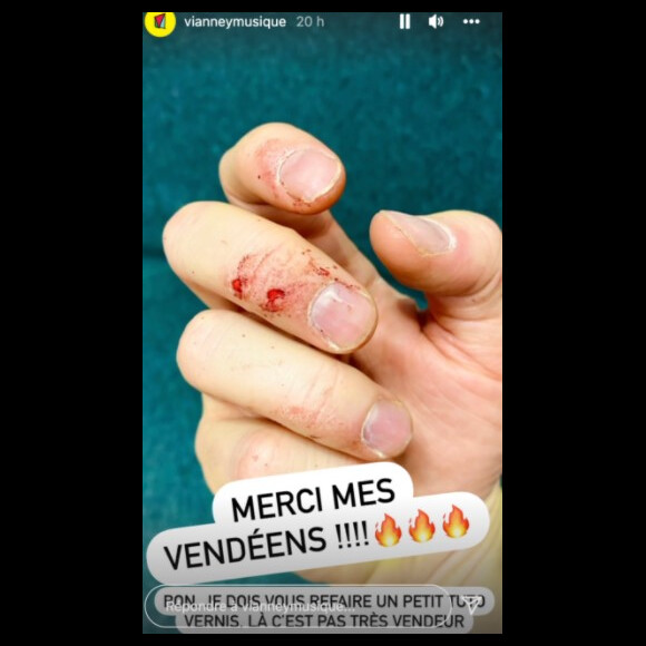 Vianney montre ses doigts englansantés après un concert. @ Instagram / Vianney