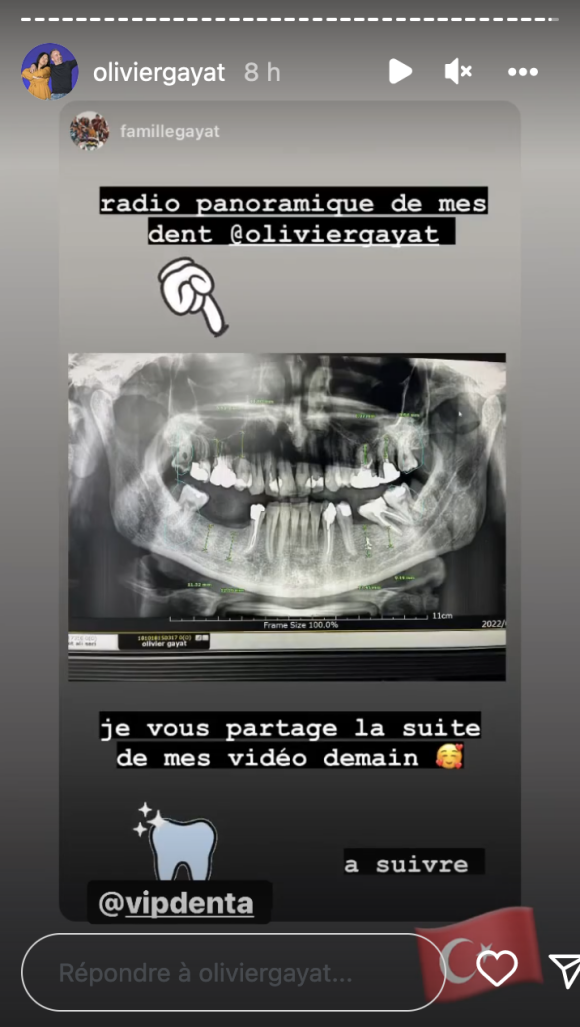 Olivier Gayat (Familles nombreuses) dévoile sa dentition - Instagram