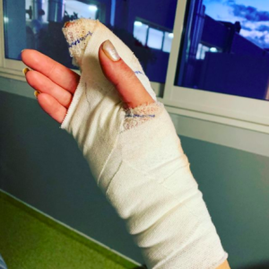 Loana dévoilé sa main après son opération.