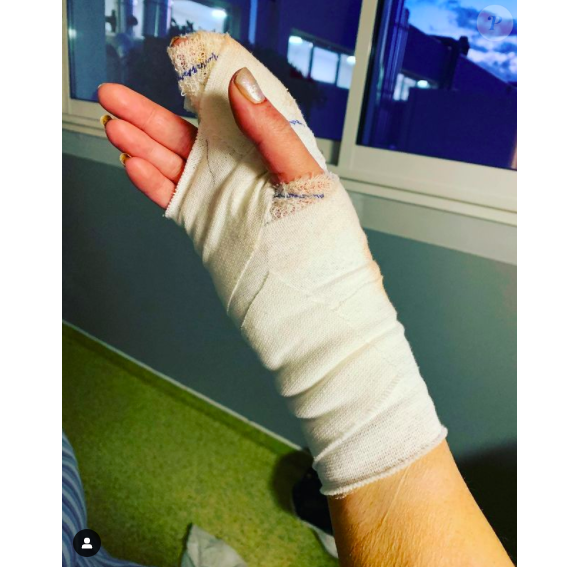 Loana dévoilé sa main après son opération.