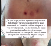 Sur Instagram, il a partagé des images impressionnantes des conséquences sur son corps.
Mathieu (L'amour est dans le pré) attaqué par des punaises de lit. Instagram