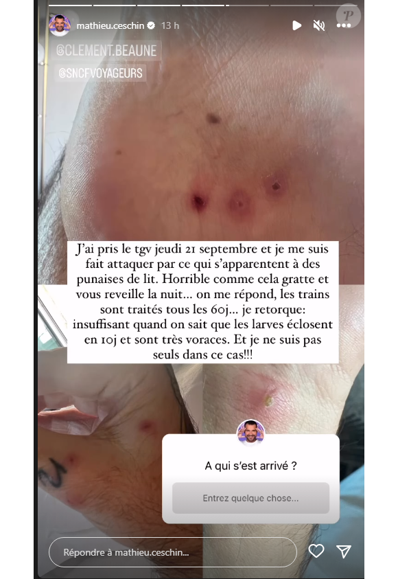 Sur Instagram, il a partagé des images impressionnantes des conséquences sur son corps.
Mathieu (L'amour est dans le pré) attaqué par des punaises de lit. Instagram