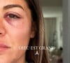 Elle a raconté en détails son agression sur Instagram
Anaïs Camizuli révèle avoir été frappée par un inconnu dans la rue le 12 novembre 2023.