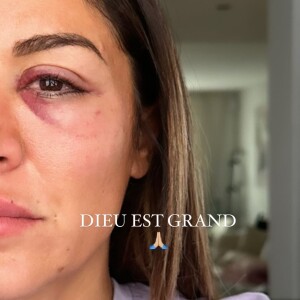 Elle a raconté en détails son agression sur Instagram
Anaïs Camizuli révèle avoir été frappée par un inconnu dans la rue le 12 novembre 2023.