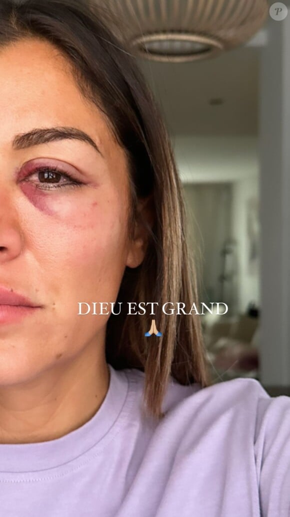 Elle a raconté en détails son agression sur Instagram
Anaïs Camizuli révèle avoir été frappée par un inconnu dans la rue le 12 novembre 2023.