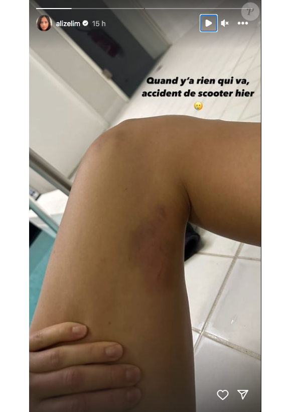 Sur la photo, on peut voir qu'Alizé Lim a été victime de grosses ecchymoses