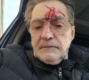 Il y a quelques jours, ce dernier a partagé une photo de lui le visage ensanglanté suite à une agression de rue. 
Michel Bimier, acheteur d'"Affaire conclue", révèle s'être fait agresser sur Instagram